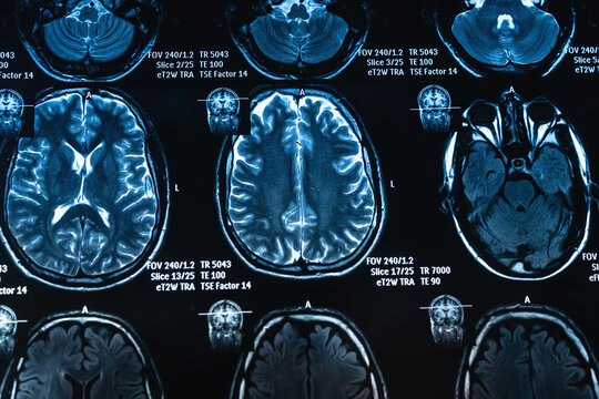Magnetic resonance imaging of brain