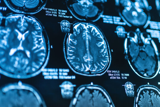 Close up brain imaging from MRI examination