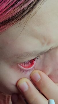 Applying eye drops to soothe irritation in a person's eyes