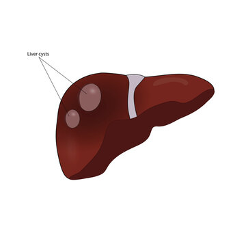 Liver cyst vector illustration