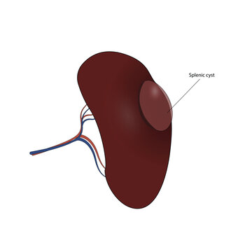 Splenic cyst vector illustration