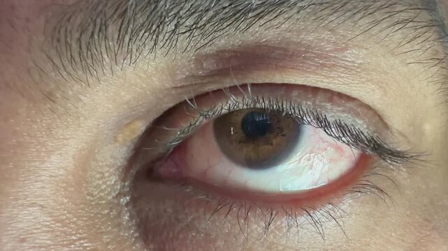Close up of a brown human eye showing mild localized conjunctival redness visible vessels and detailed iris texture near the lower eyelid