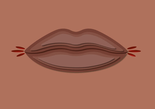 Cracked lips, conceptual illustration