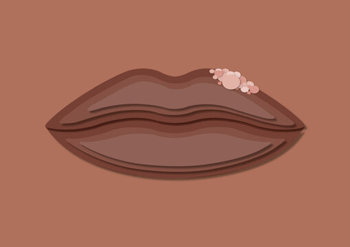 Cold sore, conceptual illustration