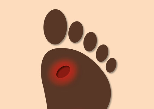 Foot ulcer, conceptual illustration