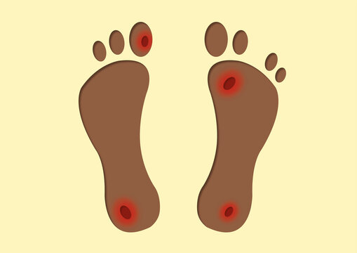 Foot ulcers, conceptual illustration