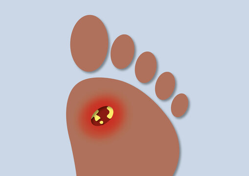 Foot ulcer, conceptual illustration