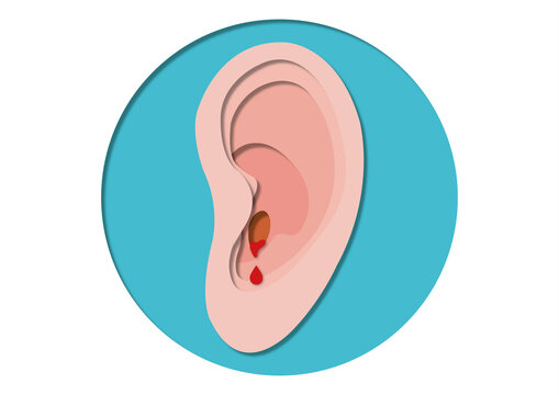 Bleeding ear, conceptual illustration
