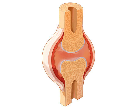 Early rheumatoid arthritis, illustration
