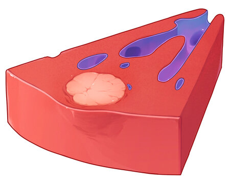 Liver cancer TNM stage T1b, illustration