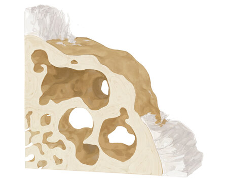 Severe osteoarthritis, illustration