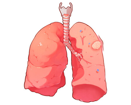 Lung cancer stage T2b, illustration