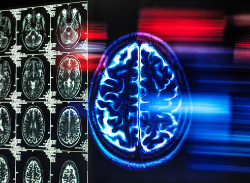 A monitor displays an MRI brain scan for dementia research