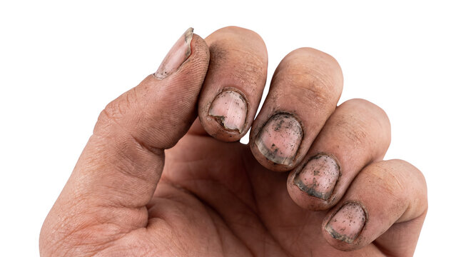 Dirty fingers of a laborer show damaged fingernails and rough skin caked with black grime against a bright transparent background.