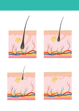 Hair loss from dht hormone diagram showing follicle destruction.