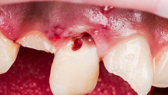 Close-up clinical view of traumatic injury to the upper front teeth, showing a fractured and displaced tooth with bleeding and damaged gum tissue. Dental trauma requiring examination