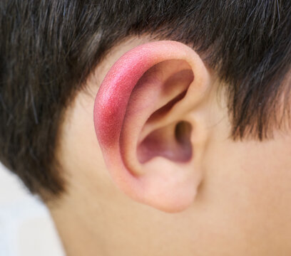 Close-up of an ear with an insect bite.
