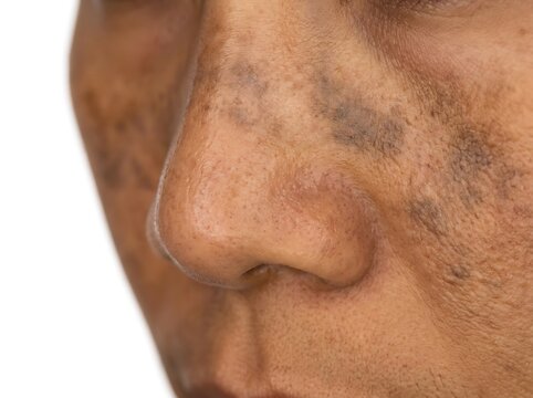 Close up view of human skin showing hyperpigmentation and sun damage on the cheek and nose area