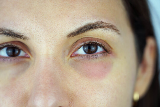 Eyelid dermatitis concept. Detail of young woman eye with eyelid dermatitis and periorbital skin inflammation.