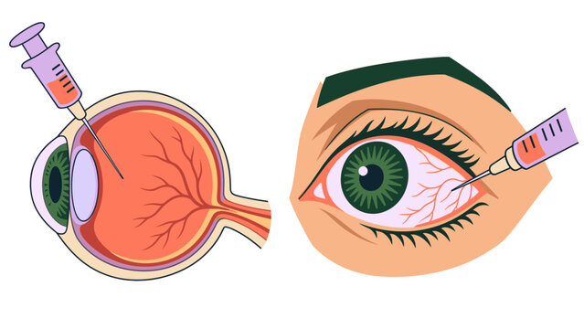 Eye cross section and intravitreal injection procedure