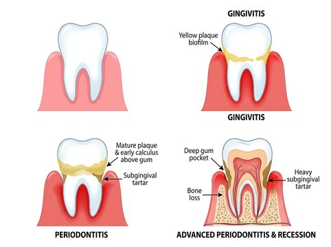Stages of periodontal disease showing gingivitis and periodontitis progression