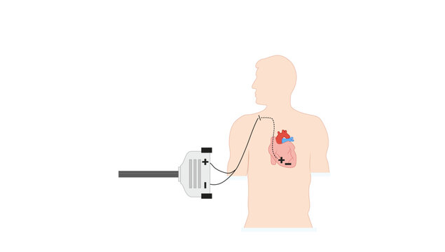 Transvenous Pacing, Medical illustration showing the placement of a cardiac pacemaker, with the pacemaker device positioned beneath the skin of the upper chest 