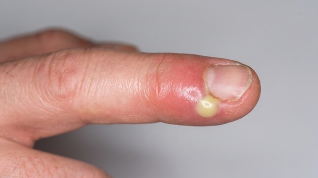 Macro view of an infected finger tip showing yellow pus and paronychia