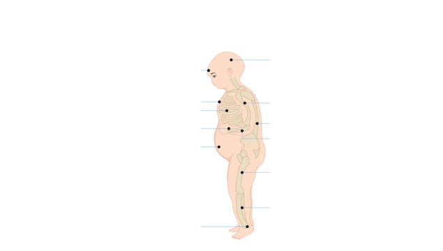 Rickets, Medical illustration showing a side-profile view of the human body with highlighted anatomical reference points, 