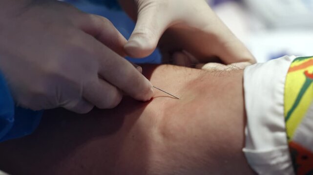 Close up of needle insertion during venous blood collection. Blood sampling procedure from patient vein for medical test and laboratory analysis.