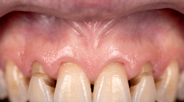 Gingival recession on adult teeth caused by hard brushing