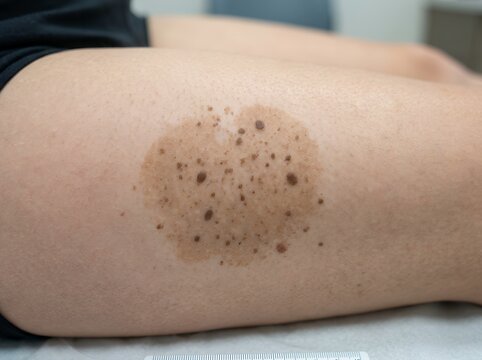 Skin pigmentation spots on leg showing various brown freckles and discoloration a close up view of the skin area