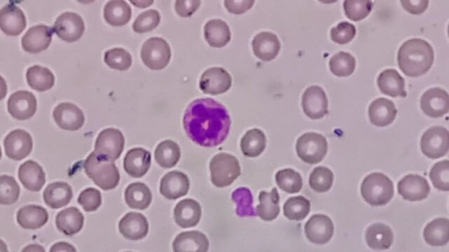 Acute leukaemia (AL). Microscopic footage. WBC shows left shift, atypical looking large mononuclear cells with 1-2 nucleoli.