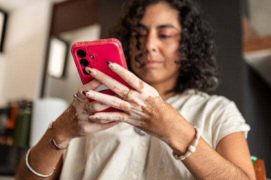Woman with vitiligo using smartphone at home