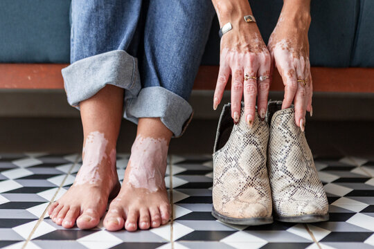Woman with vitiligo holding snake print ankle boots