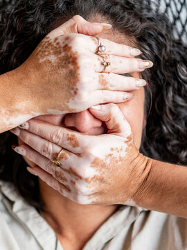 Woman with vitiligo cover face with spotted hands
