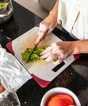 Woman with vitiligo chop lettuce for fresh salad