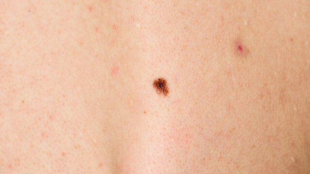 Close-up of a dark, irregular mole on a person's skin, highlighting dermatological issues.