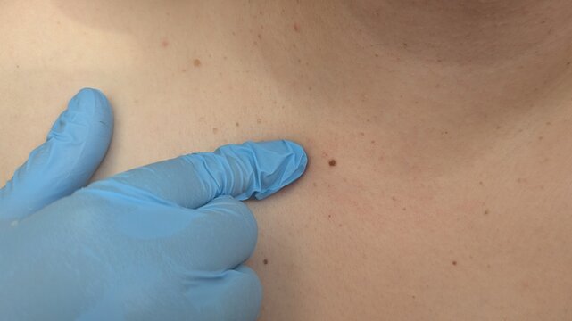 Close-up of a dermatologist's gloved finger examining a small skin mole on a patient's back. Medical concept illustrating skin cancer screening, mole evaluation, dermatology and early detection.