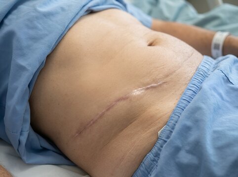 Close up of abdominal scar and skin post surgery showing surgical incision and healing process on the body