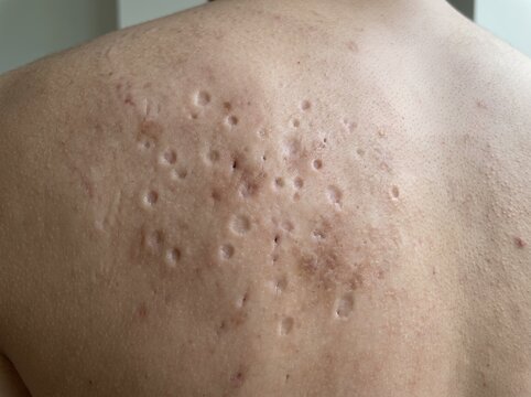 Close up view of back skin showing acne blemishes and skin texture details on the shoulder area