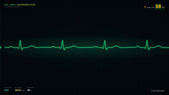 Heartbeat Monitor Shows Normal Rhythm then Flatline Cardiac Arrest.
