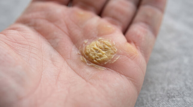 Human hand showing a prominent skin callus on the palm, symbolizing skin health concerns, chronic irritation, the need for medical attention, and discomfort