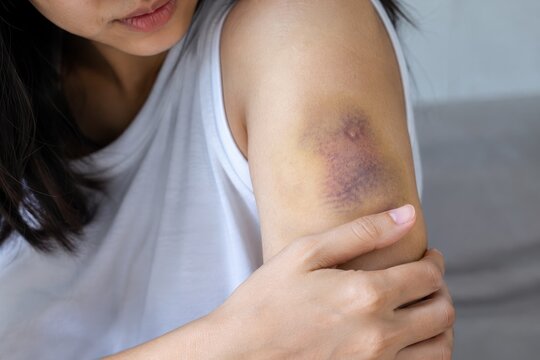 person showing a purple bruise on an arm
