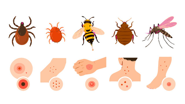 Insect bites and stings with skin reaction examples