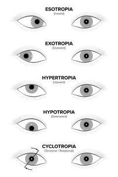 Types of strabismus, squint, heterotopia, or crossed eyes disorder, where eyes do not properly align with each other. An eye can deviate inward, outward, upward, downward, or its axis rotates. Vector