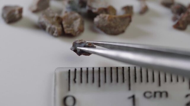 Fragments of a kidney stone crushed by ultrasound with a diameter of 1.5 centimeters