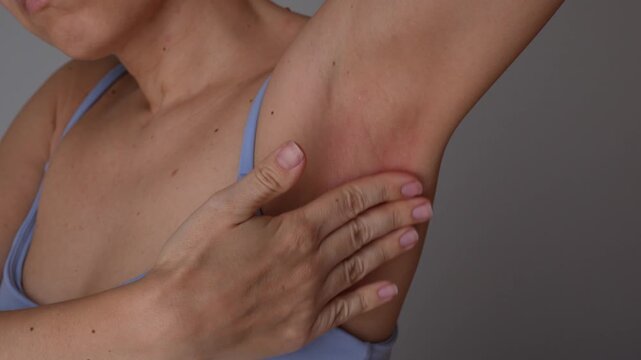 Young woman applies cream to irritated armpit on gray background, treating redness, rash, allergy, dermatitis and skin reaction after shaving or epilation