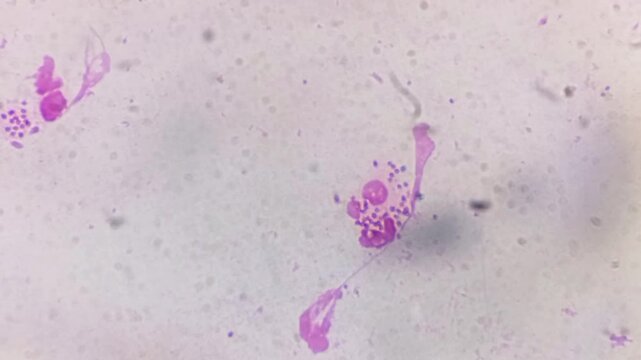 Microscopic footage of urethral smear for Gram stain. Gram negative intra and extracellular diplococci are seen.