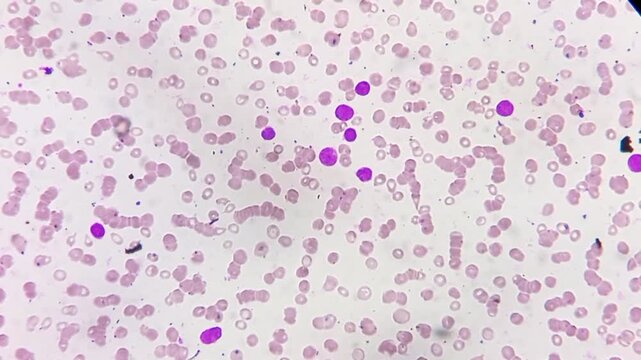 Acute leukaemia (AL). Microscopic footage. WBC shows left shift, predominant cells are atypical looking mononuclear cells with large nuclear, scanty cytoplasm, loose chromatin, 1-2 nucleoli.
