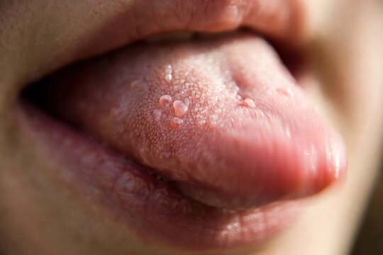 Extreme close up of a Caucasian person showing their tongue with enlarged papillae bumps on the surface, oral health condition, macro view of taste buds and rough pink texture